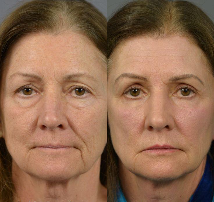 Instant Under-Eye Lift & Smooth Serum